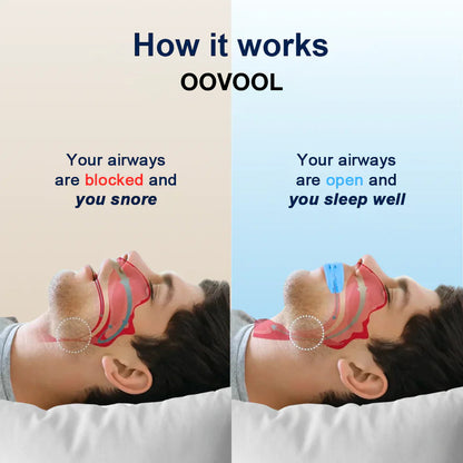 OOVOOL™  Professional intelligent anti-snoring device